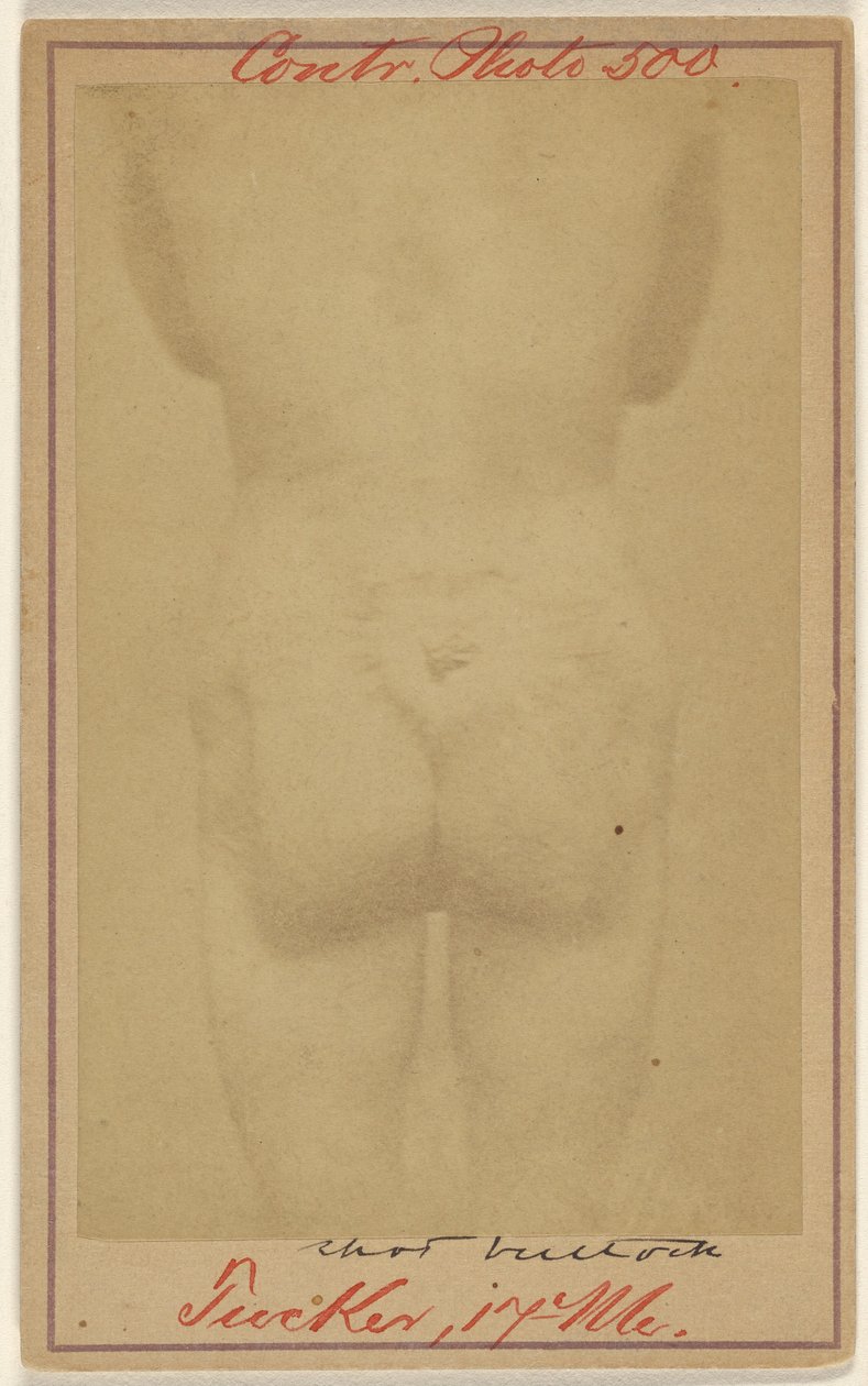 [Jno. E. Tucker, blessé par balle aux fesses, victime de la guerre civile]. - Unknown artist