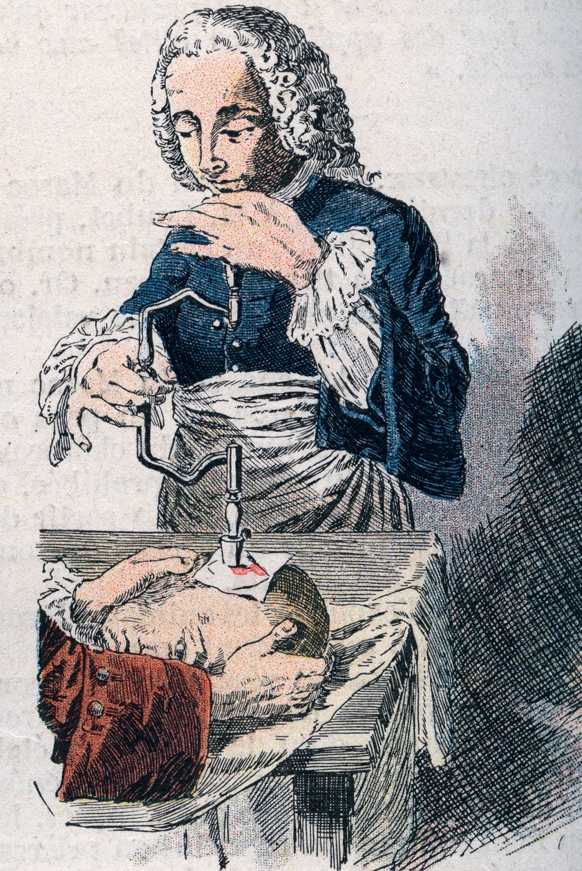 La trépanation. Estampe du 18ème siècle - Unknown artist