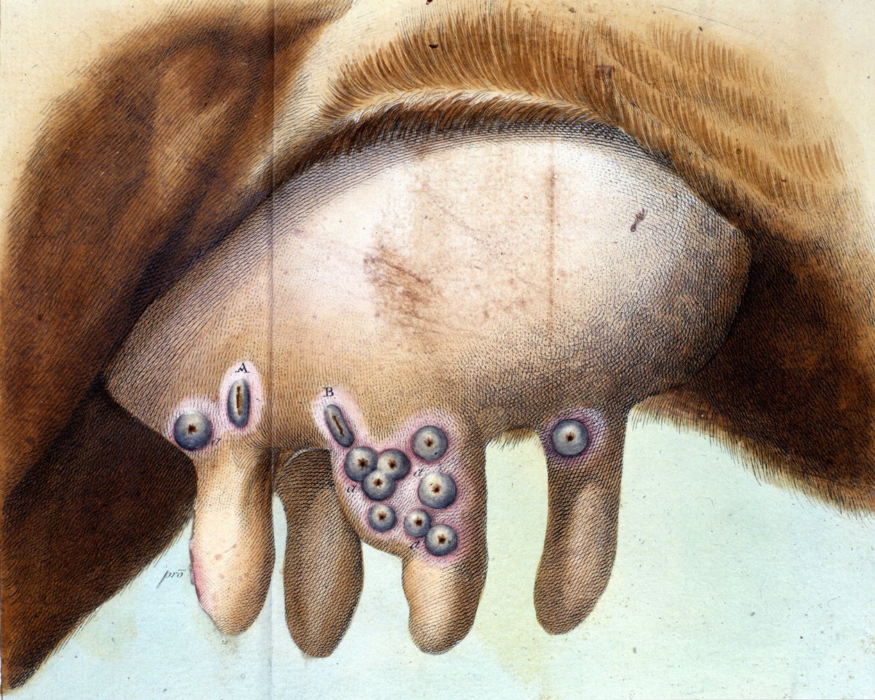 Le sein de la vache utilisé pour inoculer le vaccin contre la variole par Luigi Sacco (1769-1836) en janvier 1801. Planche médicale de « Traité de la vaccination » par Luigi Sacco, Milan - Unknown artist