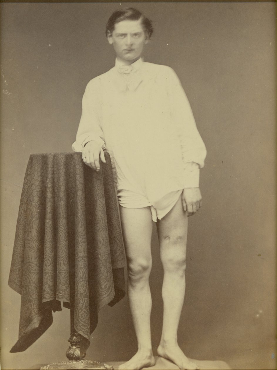 Soldat blessé de la guerre civile (Charles Westerfield, spécimen n° 4278 du musée médical de l