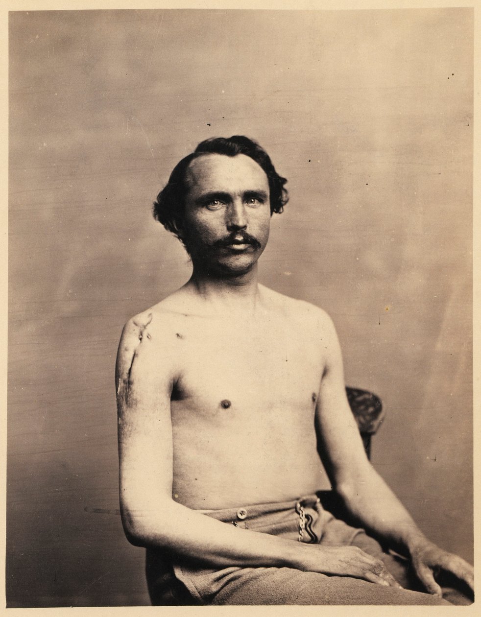 Soldat Adolph Zirsse, Excision intermédiaire réussie de la tête et de deux pouces et demi de la tige de l