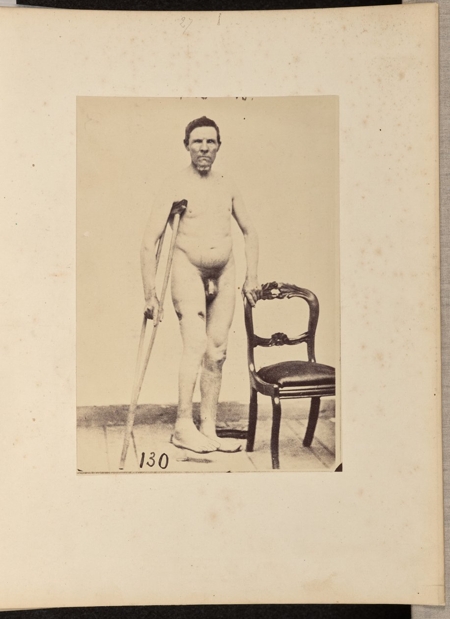 Fracture consolidée par balle du tiers moyen du fémur droit - William H. Bell