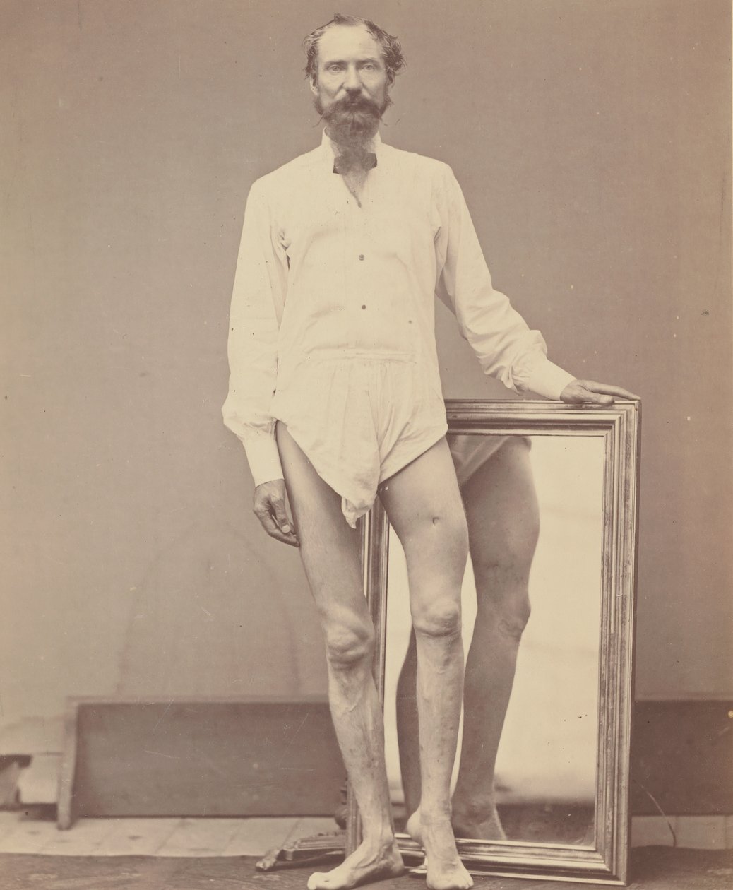 Blessure par balle du tiers moyen du fémur gauche - William H. Bell