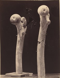 Spécimens de fractures par balle du fémur - American 19th Century