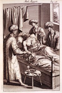 Illustration de la moxibustion de Medicina Aegyptorum par Prospero Alpinus, 1745 - American School