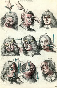 Chirurgie au XVIIIe siècle : trépanation et opération de l