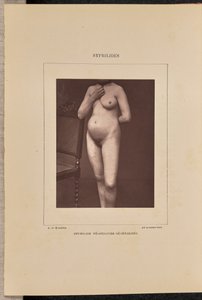 Syphilide vésiculeuse généralisée