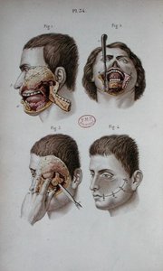 Planche anatomique de la mâchoire supérieure