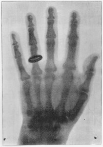 Radiographie de la main gauche d