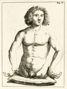 Exemple de malformations congénitales, de Exercitationes Practicae circa Medendi Methodum par Frederik Dekkers, 1694