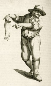 Retrait de la peau morte avec des pustules, de Exercitationes Practicae circa Medendi Methodum par Frederik Dekkers, 1694 - Dutch School