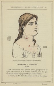 Accidents caractéristiques de la scrofulose à la période secondaire - French School