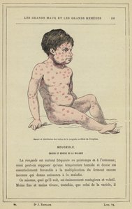 Aspect et distribution des taches de la rougeole au début de l