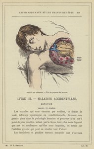 Asphyxie par submersion, Etat des poumons chez un noyé - French School
