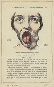 Cancer ulcéré de la langue, Dégénérescence des ganglions - French School