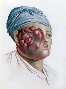 Scrofule cancéreuse, de Description des Maladies de la Peau par Baron Jean Louis Alibert, Paris, 1806 - French School