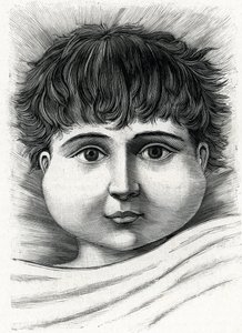 Enfant avec la maladie des oreillons (gravure) 1888 - French School
