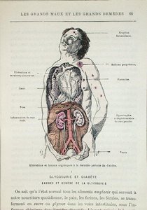 Effets du diabète, tiré de 