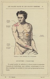 Éruptions de nature arthritique chez un rhumatisant - French School