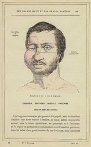 Érysipèle de la face en voie de progression - French School