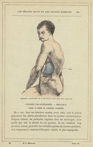 Gonflement caractéristique de la rate dans le cours d