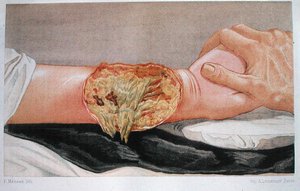 Gangrène hospitalière, de 