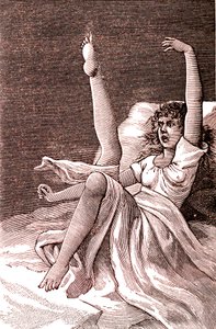 Hystérie, un phénomène mental extrême, psychoses et psychonévroses. 1887 - French School