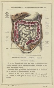 Inflammation du gros intestin, Lésions caractéristiques de la dysenterie - French School
