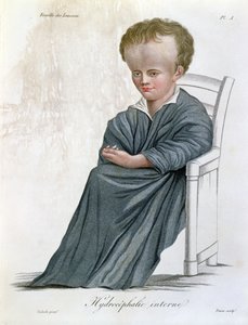 Hydrocéphalie interne, de Nosologie Naturelle par Baron Jean Louis Alibert (gravé par Tresca, 1817)
