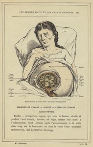 Kyste aréolaire de l