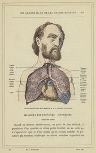Lésions caractéristiques de la bronchite et de la dilatation des bronches - French School