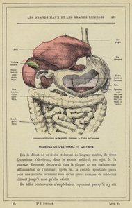 Lésions caractéristiques de la gastrite ulcéreuse, Ulcère de l