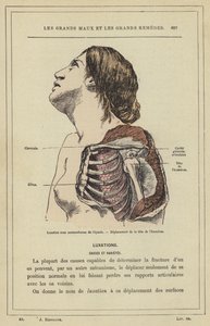 Luxation sous coracoïdienne de l