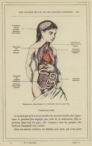Manifestations caractéristiques de la tuberculose chez une jeune fille - French School