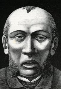 Patient avec ramollissement cérébral (gravure) 1888