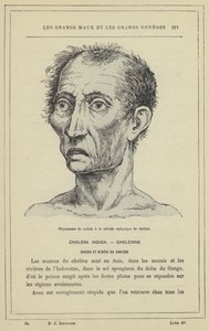 Physionomie du malade à la période asphyxique du choléra - French School