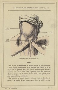 Position de la lancette dans la saignée du bras - French School
