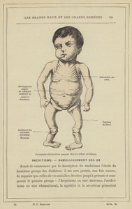 Principales déformations osseuses chez un enfant rachitique - French School