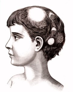 Teigne sur un enfant. 1887 (gravure) - French School
