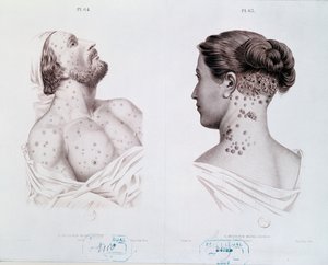 Symptômes de la syphilis chez les hommes et les femmes, d