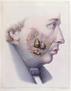 Les symptômes faciaux de la maladie vénérienne, de Traité Complet des Maladies Vénériennes par Philippe Ricord, 1851 - French School