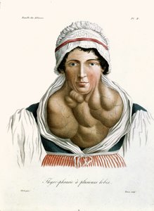 Maladie de la thyroïde, d