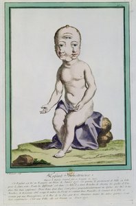 Enfant avec une tête déformée, de 