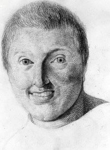 Un épileptique, dans « Étude de la physiognomie des aliénés », dessin de Gabriel - Georges Francois Gabriel