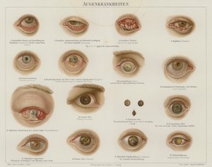 Troubles oculaires