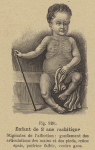 Enfant de trois ans souffrant de rachitisme - German School