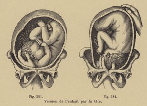 Tourner un bébé dans le ventre de sa mère pour que la tête soit orientée vers le bas avant la naissance