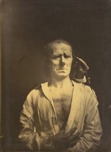 Spasme du m. corrugator supercilii sous une lumière très forte (gauche); Un visage détendu (photographié en plein soleil) (droite) - Guillaume Benjamin Amant Duchenne