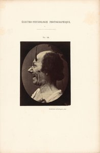 Électro-Physiologie Photographique, Figure 39 - Guillaume Benjamin Duchenne