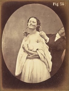 Fig. 78 - Guillaume Benjamin Duchenne